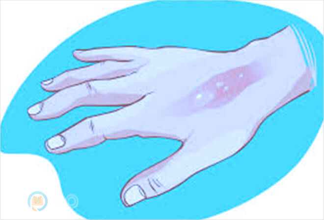 mơ thấy bị bỏng vào tay