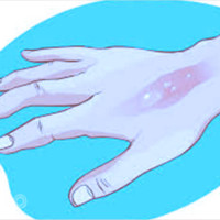 Giấc mơ bị bỏng vào tay: Dự báo biến động cuộc sống và vận may con số